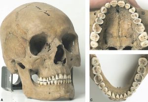 Zahnbogen eines Menschen aus der vorindustriellen Zeit