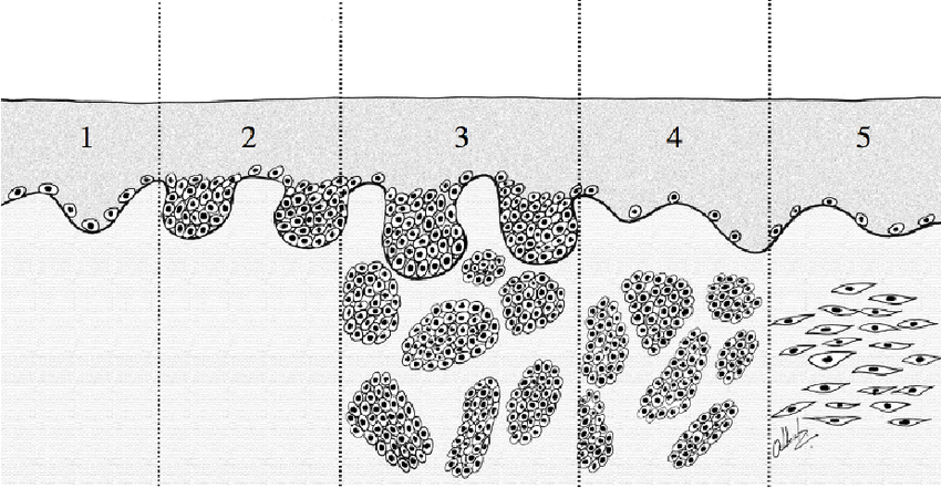 Types of melanocytic nevi